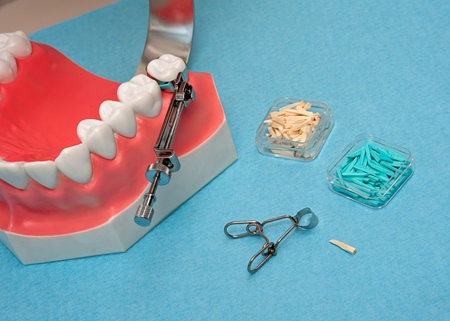 Matritzen (am Gebiss und im Vordergrund), Interdentalkeile